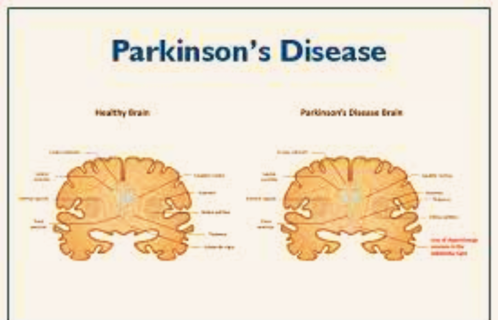 Parkinson Disease কি